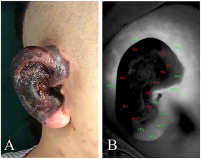 The Role of ICG Angiography in Decision Making About Skin-Sparing in Pediatric Acute Trauma